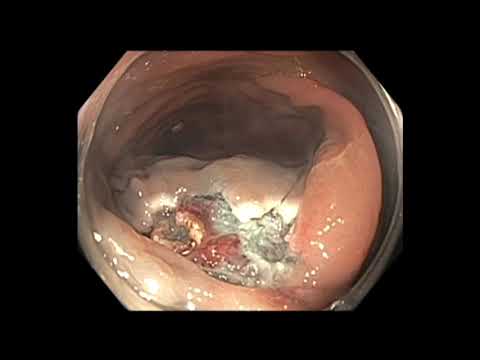 Colonoscopia - extirpación de un pólipo de colon transverso fuertemente enganchado (pólipo atado)