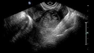 Ectopic Pregnancy, Ultrasound.  JETem 2016