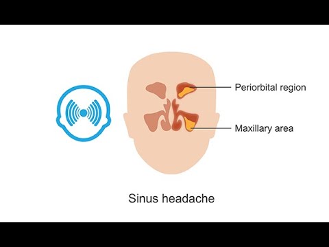 Diagnosing sinus headaches