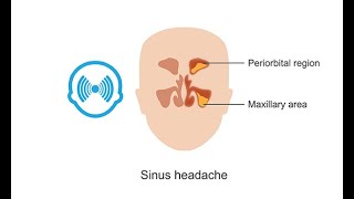 Diagnosing sinus headaches