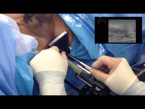 prostate ultrasound procedure video