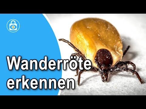 Recognizing erythema migrans: Causes, symptoms and treatment of tick bite redness