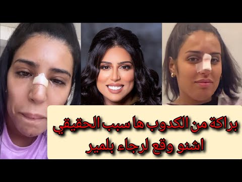 رجاء بلمير تعترف ها علاش وجهي تشوه و العملية لم تنجح