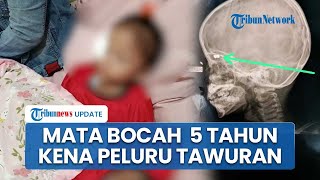 Kronologi Bocah 5 Tahun Jadi Korban Tawuran di Medan Belawan: Peluru Nyasar di Mata, Pelaku Diburu