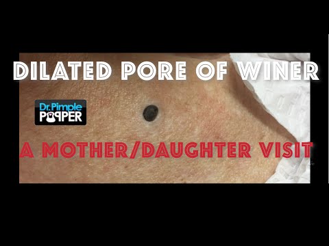 25 Grossest Pimple Popping Videos Of All Time - Zit Popping 2021