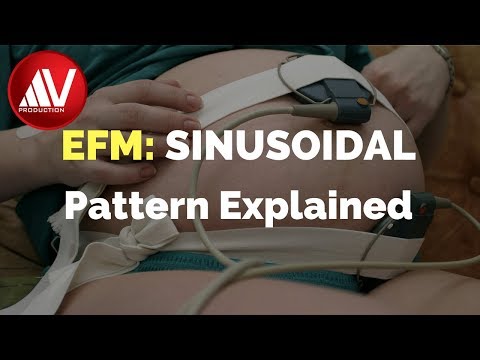 Sinusoidal pattern explained
