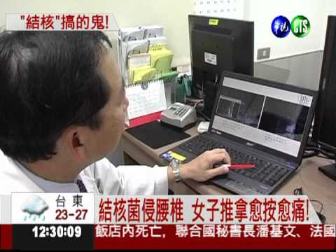 結核菌搞的鬼! 女子腰痠背痛