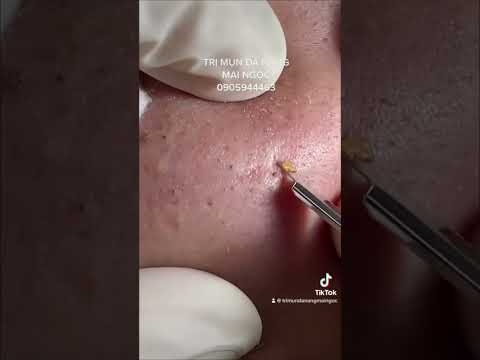 ACNE TREATMENT MAI NGỌC