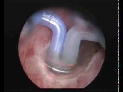 Erotische Massage Video-Tutorial Prostata Prostata-Krebs-Chemotherapie Schritt 3
