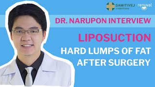 Hard Lumps Of Fat After Liposuction? Why?
