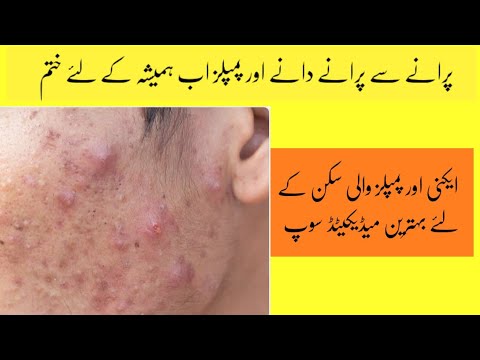 Best Medicated Soap for acne and pimples | Best acne treatment