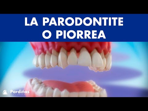 La parodontite o piorrea ©