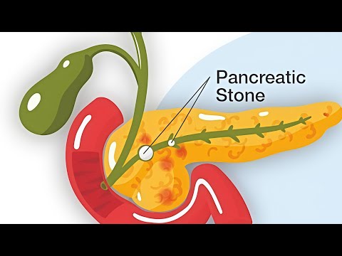 Pancreatic Stone / Pancreatic Calculi / Pancreatolithiasis