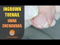 Ingrown toenail | Large spicule #podologiaintegral