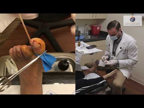 Ingrown Toenail Symptoms Video
