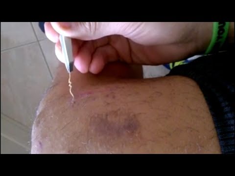 Che fare se negli occhi hypostases La faccia schiumosa imballa decoloranti