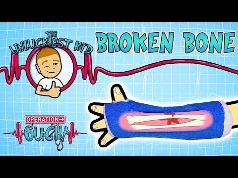 Science for kids |  BROKEN BONES- Unluckiest Kid | Experiments for kids | Operation Ouch