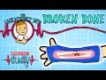 Science for kids |  BROKEN BONES- Unluckiest Kid | Experiments for kids | Operation Ouch