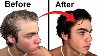 How to stop Balding | Full hair loss guide