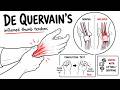 De Quervain’s Tenosynovitis: Thumb Wrist Pain (Finkelstein Test, Causes, Treatment)