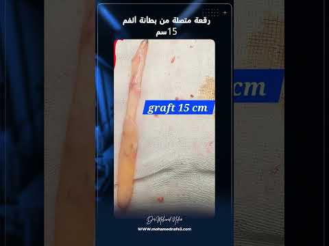 من اليأس إلى الأمل..حالة معقدة من اليمن تعرضت لقطع حالب الكلية بعد المنظار المرن