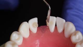 BRIDGE EN UNE SEANCE AVEC RIBBOND