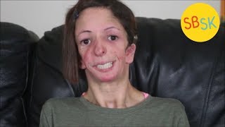 Ashley&#39;s Life with Nager Syndrome