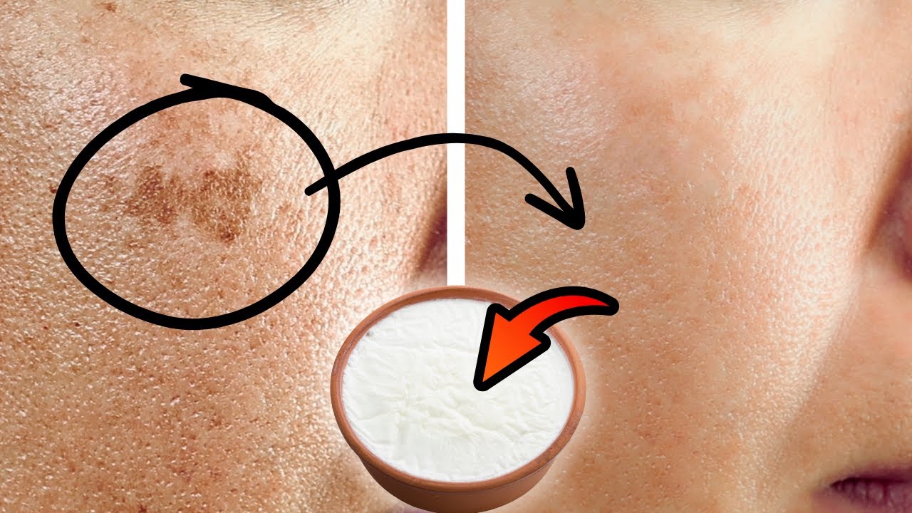 How I ERASED my age spots with a CHEAP kitchen ingredient