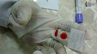 Blood smear preparation.2 methods to learn.(Thick & Thin smear preparation).