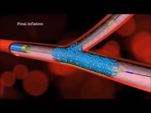 Main Branch Bifurcation Stent ("PROVISIONAL") by Advanced Bifurcation Systems