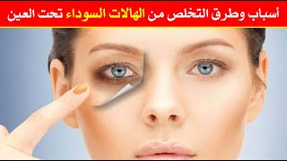 أسباب وطرق التخلص من الهالات السوداء تحت العين أسباب وطرق التخلص من الهالات السوداء تحت العين