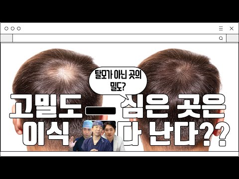 고밀도 이식은 탈모가 아닌 곳의 밀도? 심은 곳은 다 난다고 생각하면 될까요?│뉴헤어│모발이식