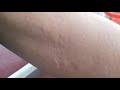 Acute Urticaria
