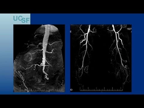 Endovascular Approaches for TASC C/D Aorto-iliac Lesions - UCSF Vascular Surgery Symposium 2013