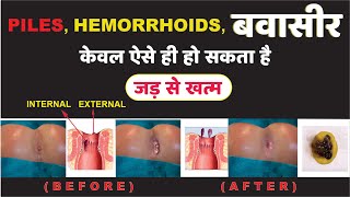 Piles Treatment || Treatment Demo Of Anti Piles Complete Resolution