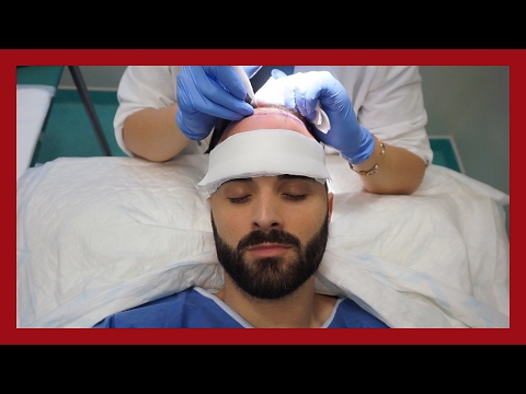 download lagu mp3 mp4 Implant Capillaire, download lagu Implant Capillaire gratis, unduh video klip Implant Capillaire