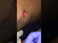 Getting A Bullet Removed At The HOOD DOCTOR