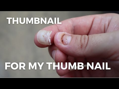 Smashed Nail Falling Off - Subungual Hematoma Time Lapse