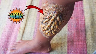 [ Worms Body ] How to Remove Worms On Dandruff #347