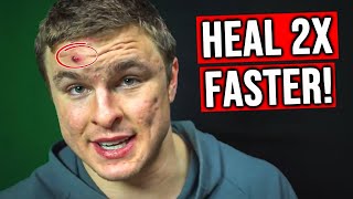 How To Heal A Popped Pimple (FASTEST METHOD)