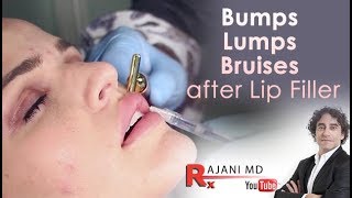 Bumps Lumps Swelling and Bruising after lip Fillers-Dr Rajani