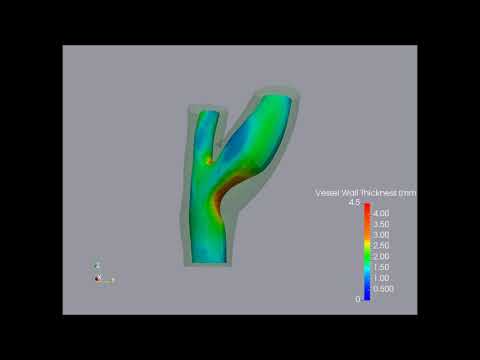 Carotid vessel wall thickness visualization