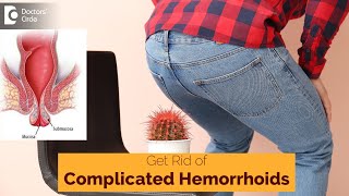 Treatment of Complicated Hemorrhoids| Strangulated  Hemorrhoids | Thrombosed Piles-Dr.Rajasekhar M R