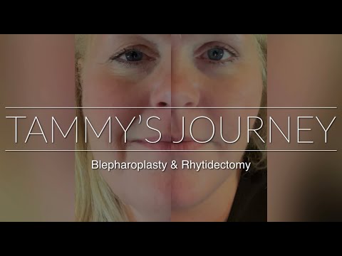 Eyelid and facelift surgery Chicago, Tammy's Journey