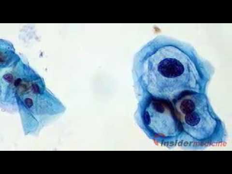 Papiloma virus humano sintomas