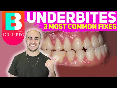 [BRACES EXPLAINED] Underbite / Crossbite Correction
