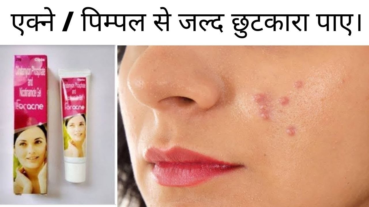 Watch video एक्ने / पिम्पल से जल्द छुटकारा पाए। /Foracne Cream #total solution#full review in hindi#QueenPriya Now एक्ने / पिम्पल से जल्द छुटकारा पाए। /Foracne Cream #total solution#full review in hindi#QueenPriya