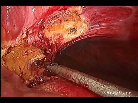 Laparoscopic Hysterectomy for Huge 8+ kg Tumor