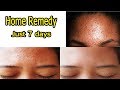 நெற்றியில் உள்ள பருக்கள் மறைய Forehead Pimples R