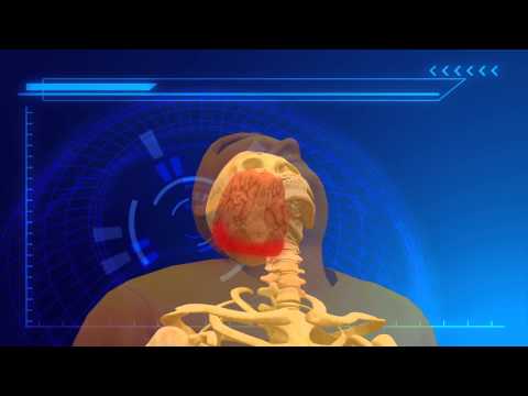 Whiplash injury may be cause of Mexican wrestler Pedro Aguayo Ramirez's death